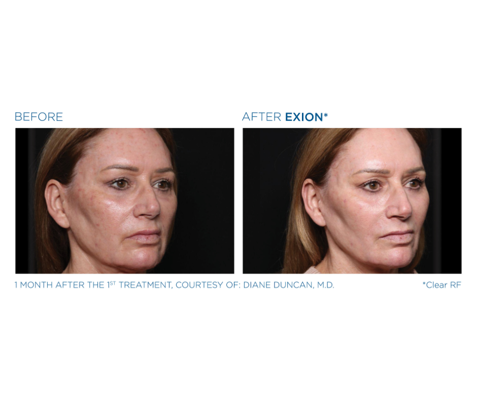 RF microneedling treatment